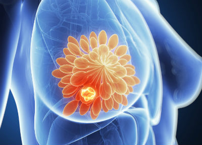 Incidência, fatores de risco e mortalidade por fibrilação atrial no câncer de mama