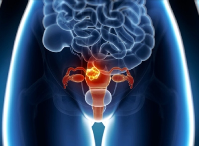 cancer endometrio 23