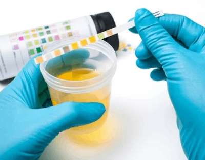 Teste de urina pode ser alternativa à cistoscopia em pacientes com alto risco de recorrência do câncer de bexiga
