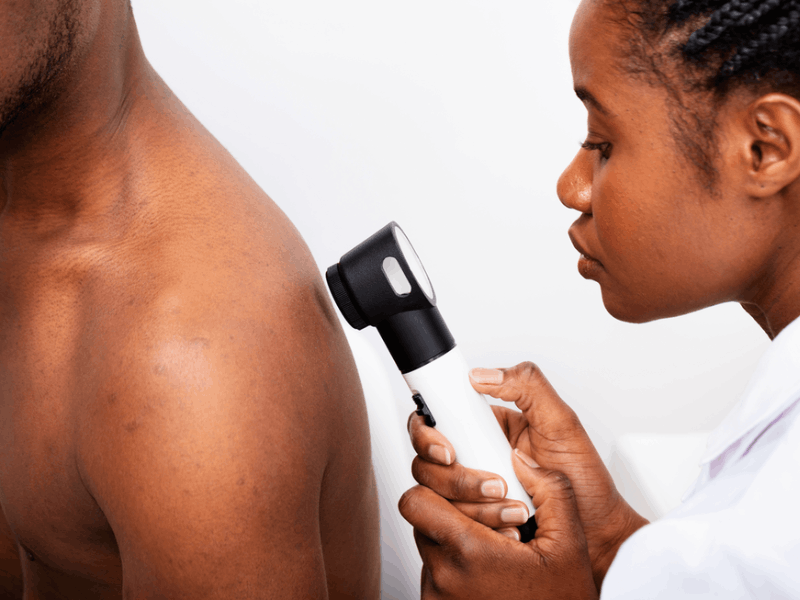 Estudo avalia apresentação distinta do melanoma em pacientes negros