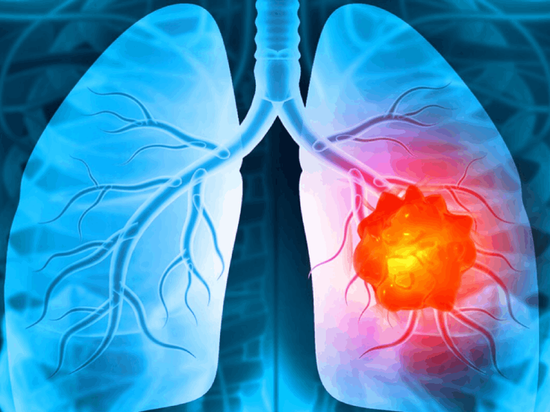 Função pulmonar prejudicada e risco de câncer de pulmão